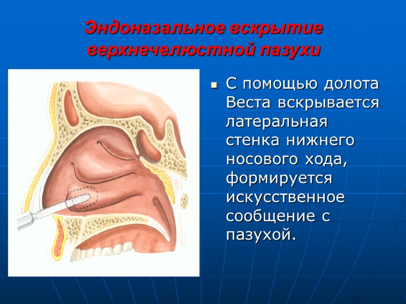 Эндоназальное вскрытие верхнечелюстной пазухи С помощью долота Веста вскрывается латеральная стенка нижнего носового хода,